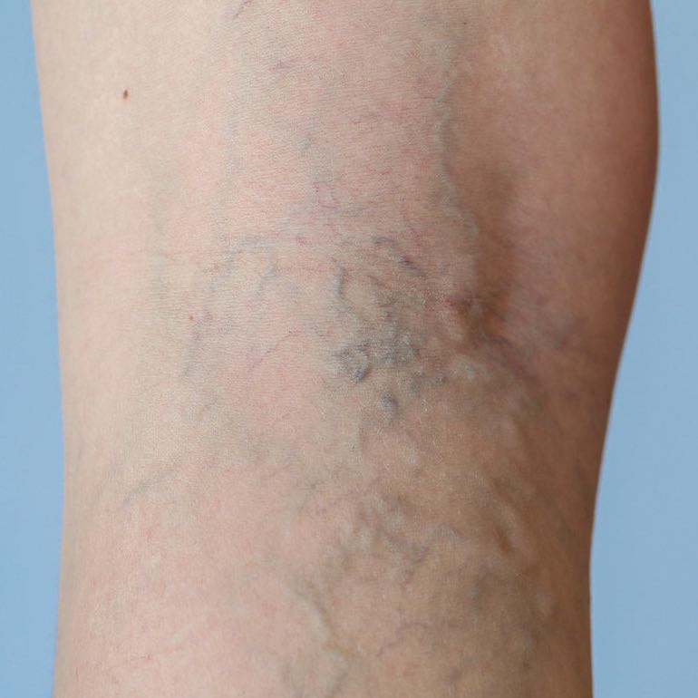 műtét a visszerek a lábakon mielőtt utána a visszerek kockázati csoportja