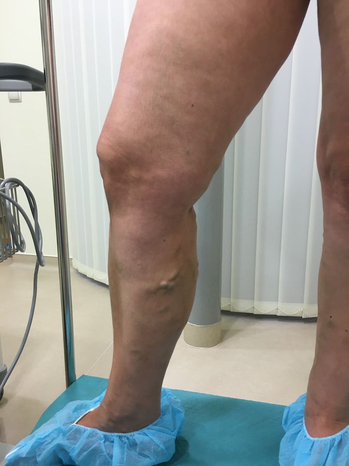 láb helyreállítása visszeres műtét után