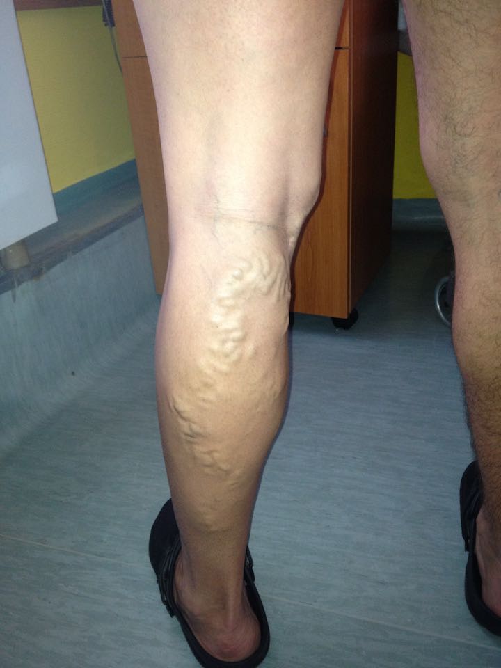 a varikózis fényképe a lábán