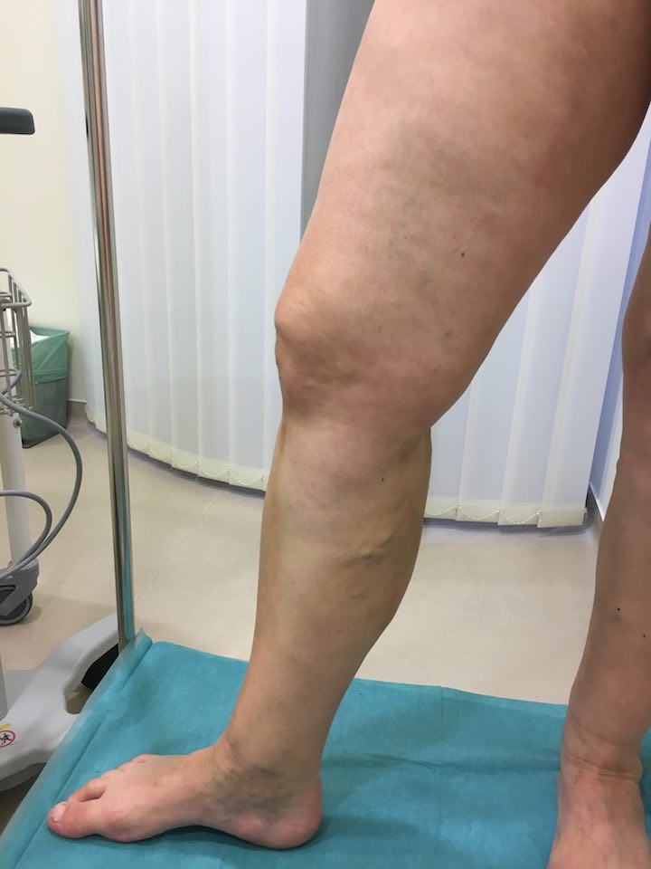 visszér műtét előnyei és hátrányai a lábak visszér tünetei